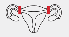 Sterilization: Tubal Methods