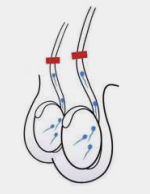 Sterilization: Vasectomy